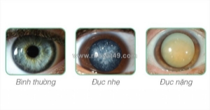 Mổ c thủy tinh thể bao nhiêu tiền và cẩm nang dùng bhyt đúng cách