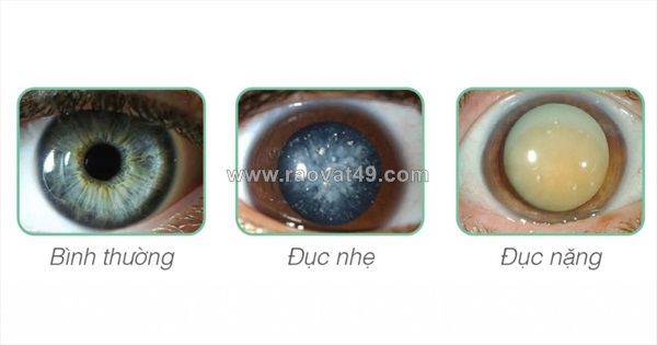 Mổ c thủy tinh thể bao nhiêu tiền và cẩm nang dùng bhyt đúng cách