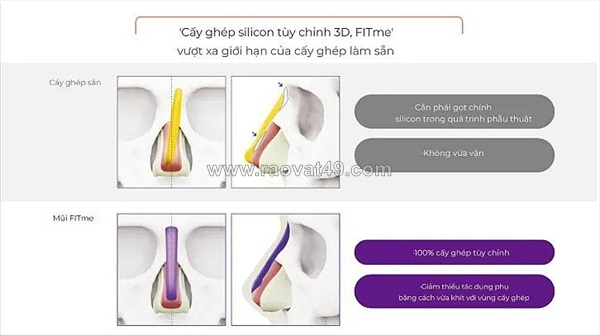 Nâng mũi 3d fitme có đặc điểm gì nổi bật?