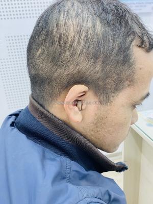 Nghe kém ở người trẻ tuổi, đừng chủ quan!