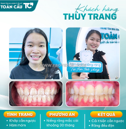 Niềng răng có giúp mặt hết lệch không?