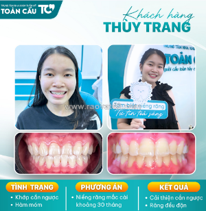 Niềng răng có giúp mặt hết lệch không?