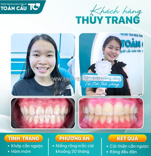 Niềng răng có giúp mặt hết lệch không?