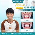 Bọc răng sứ có làm yếu răng không? hiểu đúng để tránh lo lắng