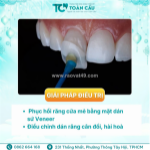 Dán sứ veneer có nhanh không? mất bao lâu để hoàn thiện?