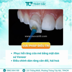 Dán sứ veneer có nhanh không? mất bao lâu để hoàn thiện?