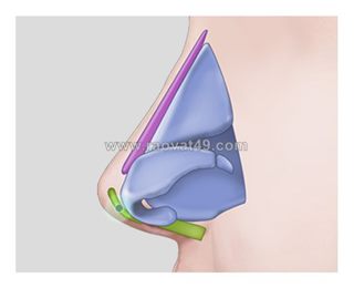 Mũi lộ sóng sau phẫu thì cần sử dụng phương pháp nào?