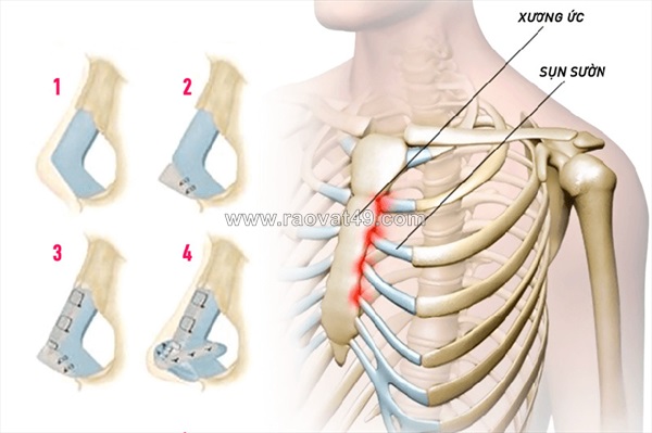 Nâng mũi sụn sườn có đảm bảo an toàn tuyệt đối không?