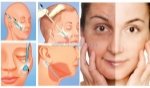 Những điều không thể bỏ qua khi chọn căng da mặt phẫu thuật