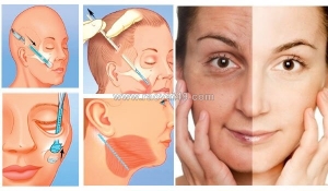 Những điều không thể bỏ qua khi chọn căng da mặt phẫu thuật