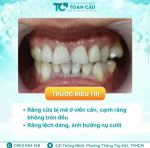 Veneer có bị đổi màu không? sau 5–10 năm răng trông thế nào?