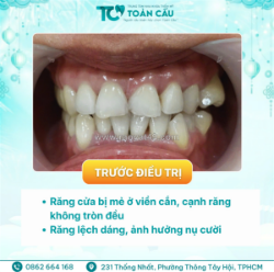 Veneer có bị đổi màu không? sau 5–10 năm răng trông thế nào?