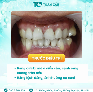 Veneer có bị đổi màu không? sau 5–10 năm răng trông thế nào?