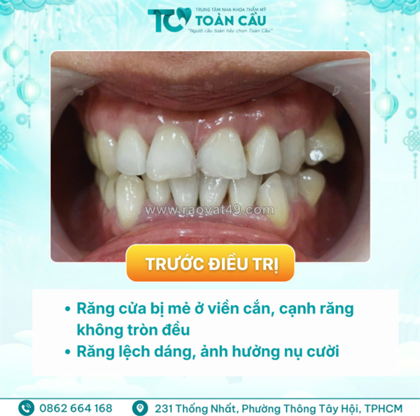 Veneer có bị đổi màu không? sau 5–10 năm răng trông thế nào?