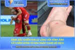Đình bắc khiến fan lo lắng với hình ảnh cổ chân sưng to sau ngày cahn vô địch