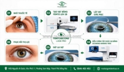 Phẫu thuật lasik: cơ chế, bảng giá và quy trình khép kín