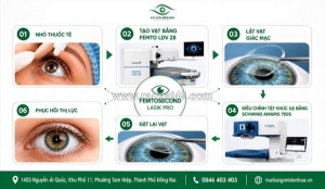 Phẫu thuật lasik: cơ chế, bảng giá và quy trình khép kín