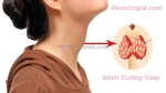Bệnh cường giáp thường gây ra chứng loãng xương